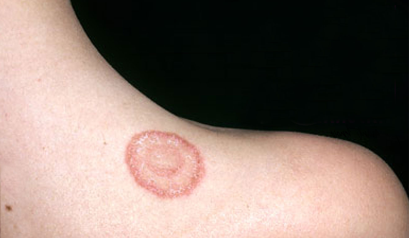 Natural Remedies to Treat Ringworm at Home - Wedandbeyond